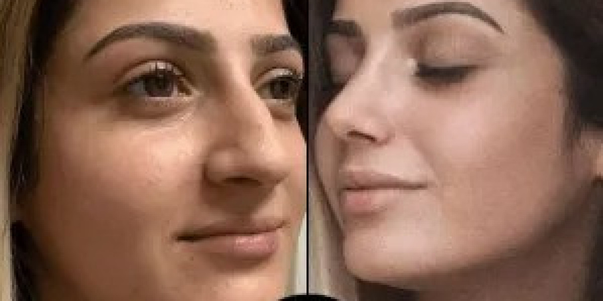 My PRP Treatment in Dubai Review – 30 Days Later